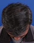 After Hair Transplant&nbsp;Front